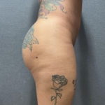 Liposuction Patient 55