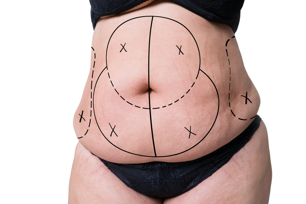 Discover the Benefits of a Tummy Tuck