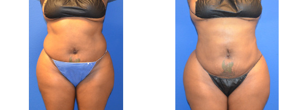 Before and After Liposuction | DFW Aesthetics and Cosmetic Surgery