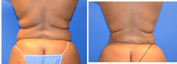 Before and After Liposuction | DFW Aesthetics and Cosmetic Surgery