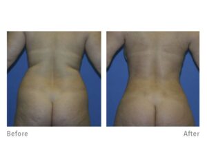 Butt Lift Before and After | DFW Aesthetics and Cosmetic Surgery