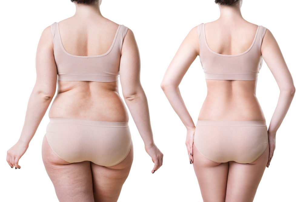The Road to Recovery: What to Expect After Liposuction | DFW Aesthetics and Cosmetic Surgery