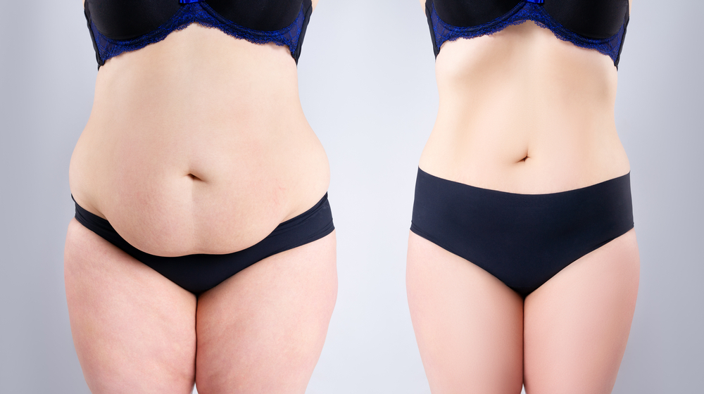 Tummy Tuck Surgery: How Long Does It Take? | DFW Aesthetics and Cosmetic Surgery