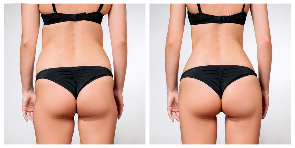 Brazilian Butt Lift | DFW Aesthetics and Cosmetic Surgery