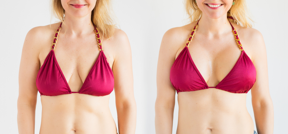Breast Augmentation | DFW Aesthetics and Cosmetic Surgery