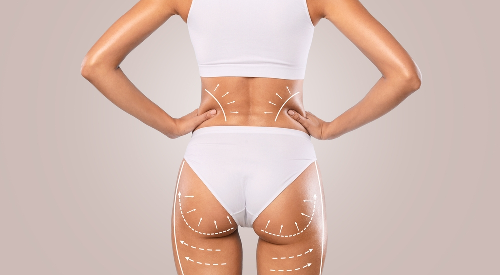 BBL vs. Traditional Butt Augmentation: Choosing the Right Path | DFW Aesthetics & Cosmetic Surgery