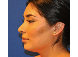 Dermal Fillers and Injections 1