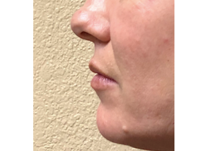 Dermal Fillers and Injections 3